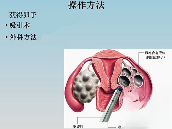 取卵过程