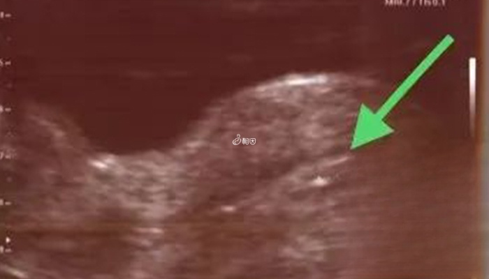 胚胎移植的位置