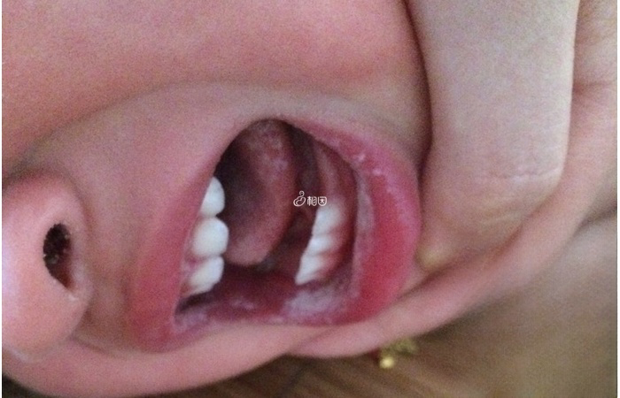 当婴儿出现鹅口疮是有几个比较明显的症状