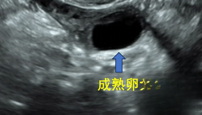 成熟卵泡一般在18mm以上