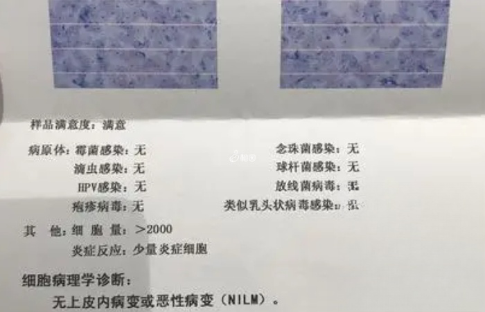 未见上皮内病变细胞或恶性细胞表示结果正常