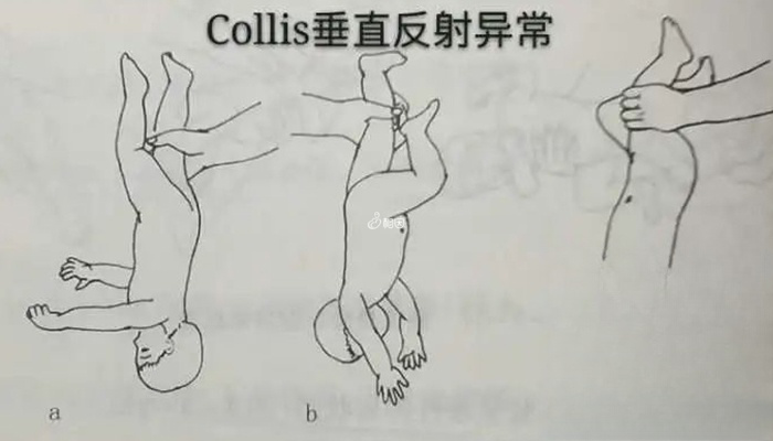 Collis垂直反射异常表现