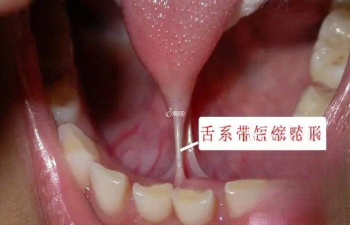 剪舌系带容易出现创口发炎