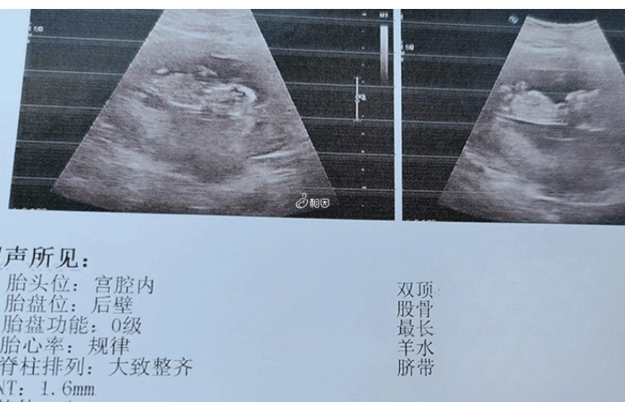 NT检查是先天愚型的早期筛查