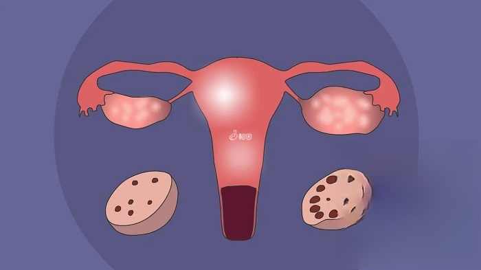 多囊卵巢综合征是一种比较常见的妇科疾病