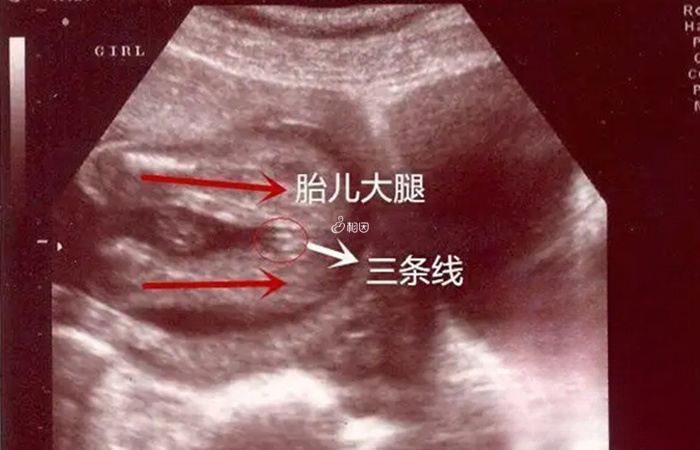 B超图像上出现三条白线生女宝的可能性大