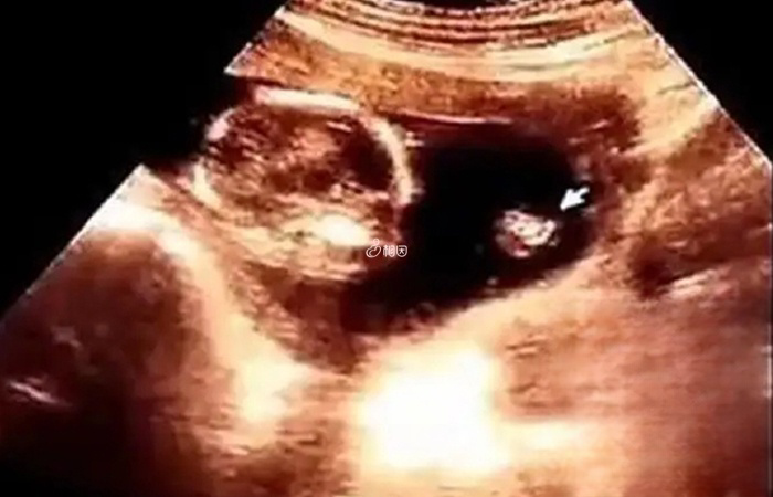 直接观察彩超图像可以判断出胎儿的性别