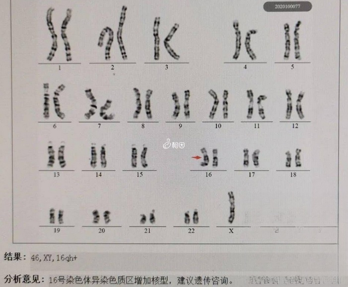 染色体异常分为形态、数目以及结构变异