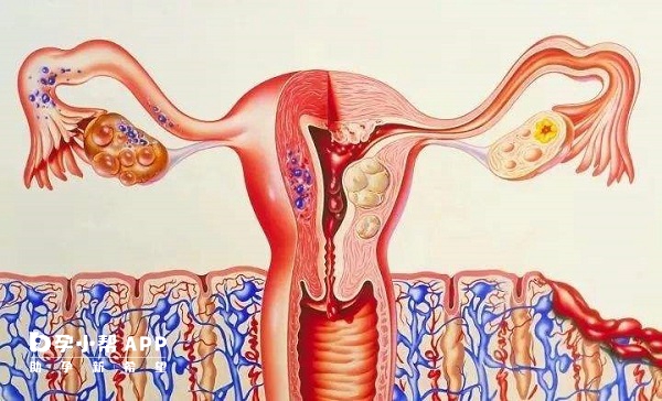 子宫内膜异位症可适当注射抑那通进行治疗