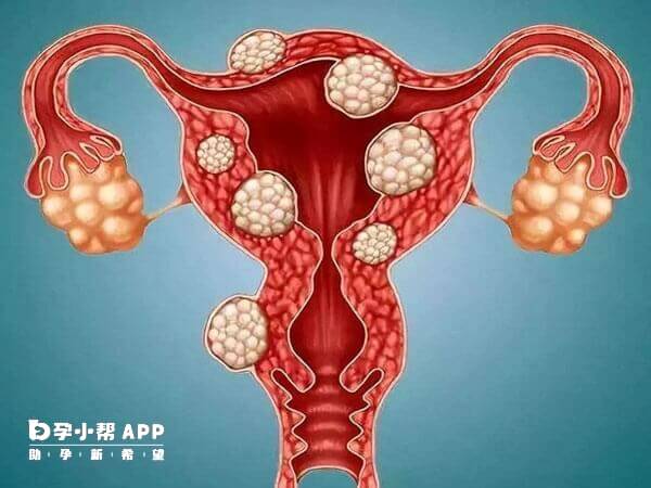 多发性子宫肌瘤需要手术治疗