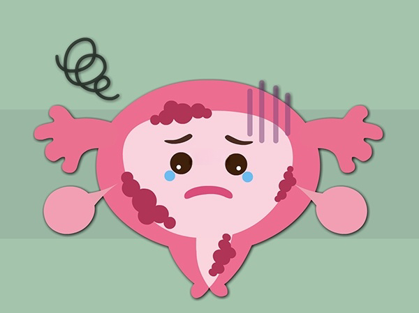子宫内膜异位症可造成盆腔黏连