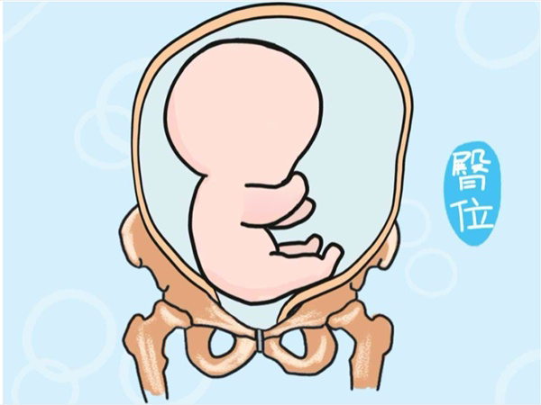 臀位就是胎儿在分娩时先露臀