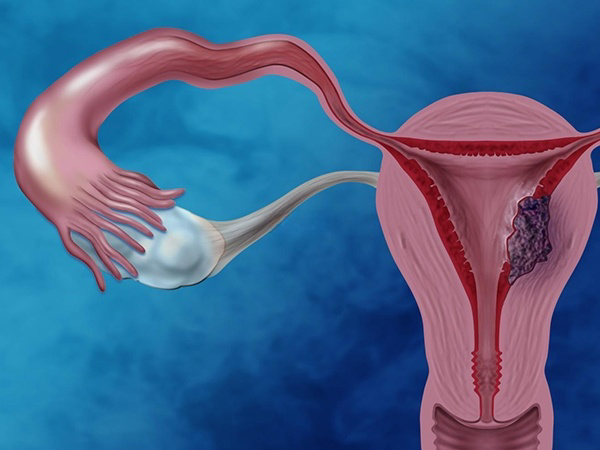 输卵管堵塞导致精子与卵子无法相遇