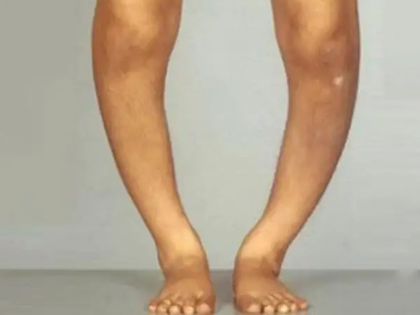 佝偻病孩子腿部图片