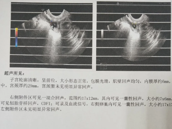 宫外孕无需保胎