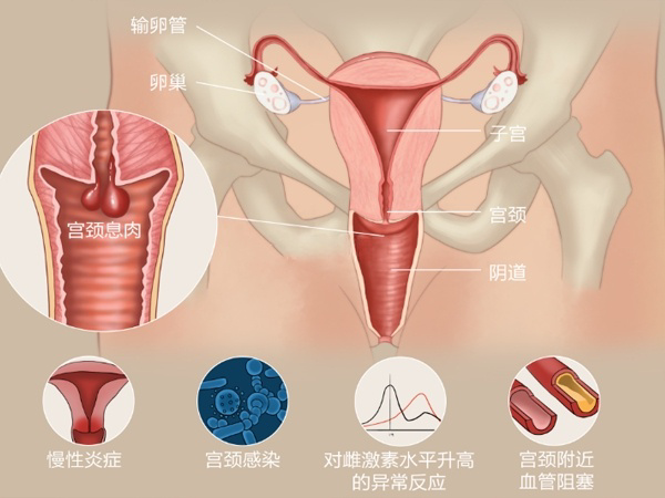 宫颈机能不全不建议做试管婴儿