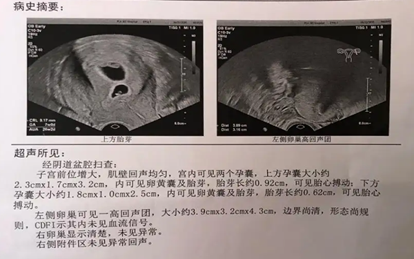 移植一个鲜胚变双胎几率低