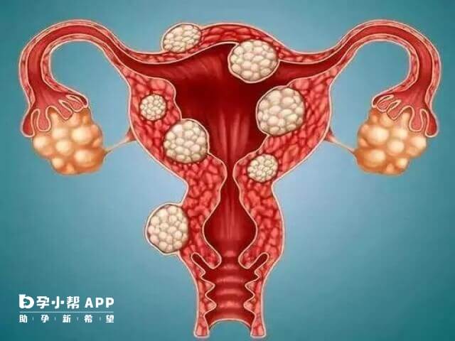 多囊卵巢不治疗会导致不孕