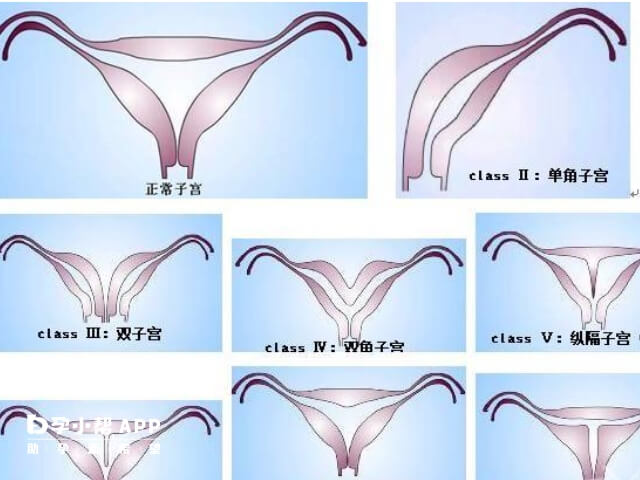 双角子宫不是一碰就怀孕