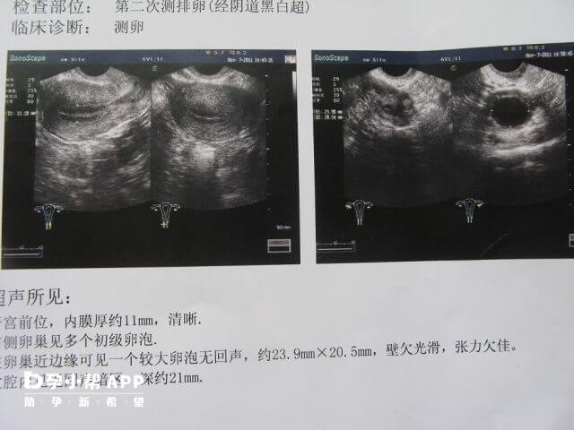 促排4天后卵泡大小8-10mm正常