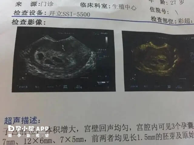 通过孕囊发育声像图大小判断怀孕天数