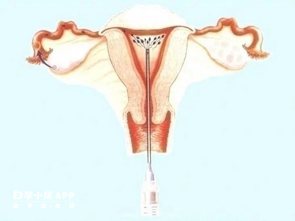 精液是液化前注入注射器
