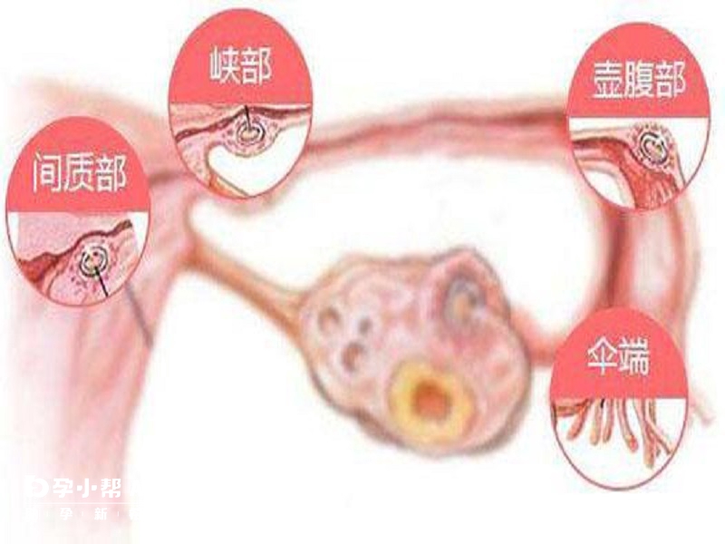输卵管堵塞应及时治疗