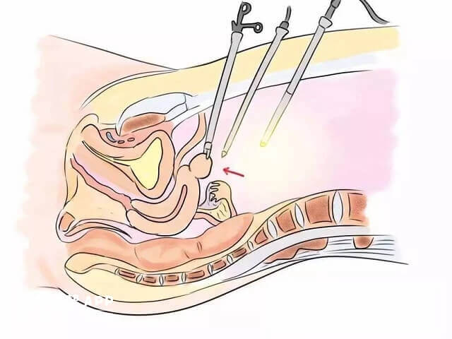 宫腹腔镜手术过程